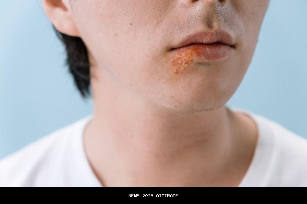 7 Cara Cegah Penyebaran Herpes, Kondom Wajib!
