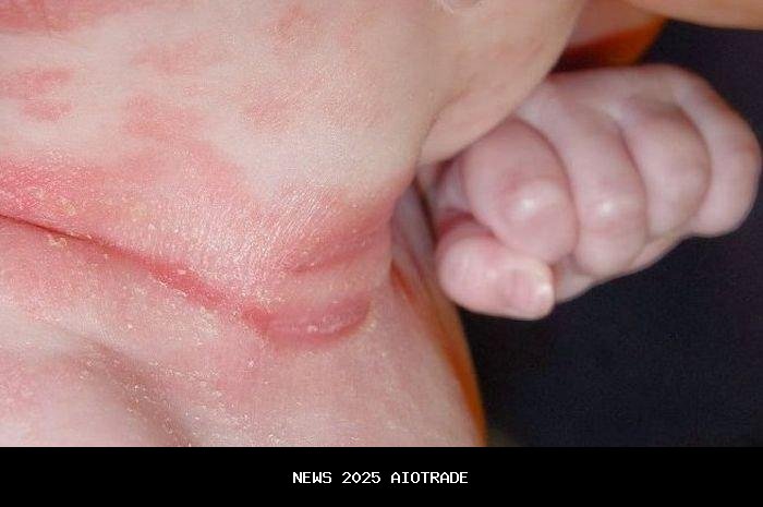 5 Cara Sederhana Mengatasi Leher Merah dan Lecet pada Bayi