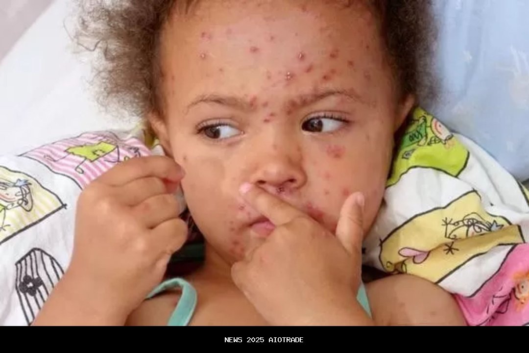 KLB Campak Sumenep Capai 2.000 Kasus, 17 Kematian Termasuk 16 yang Tidak Imunisasi