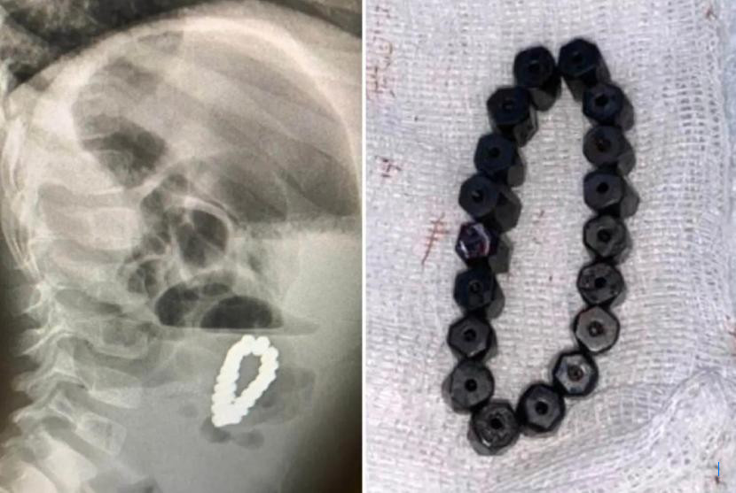 Remaja Selandia Baru Telan 100 Magnet, Dokter Operasi Usus Rusak