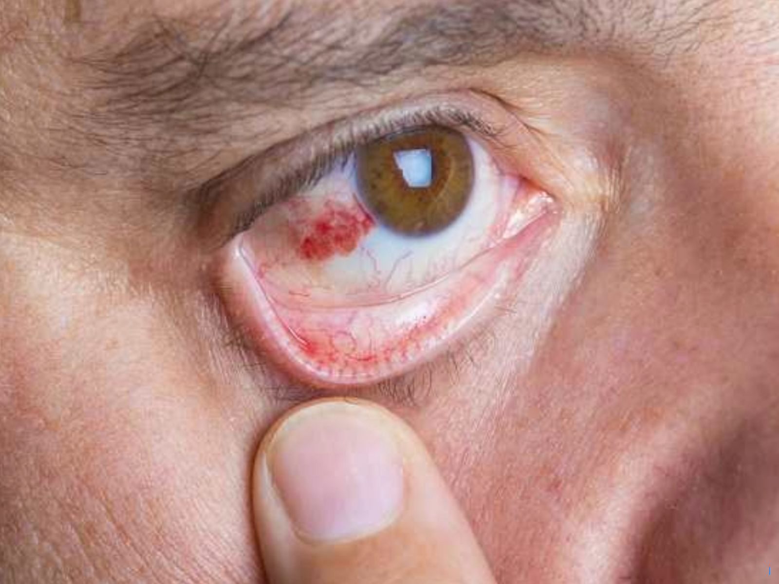 Fakta di Balik Mata Berdarah yang Sering Dianggap Menular, Ini Penyebabnya